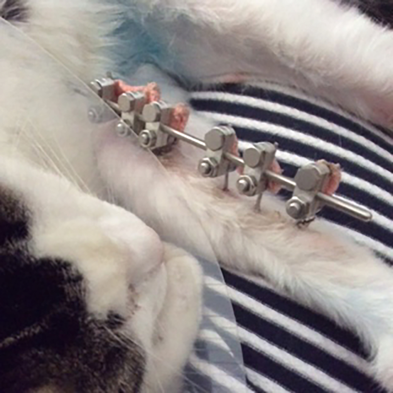 An external fixator on Jimmy's leg